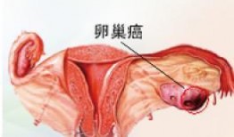 卵巢癌患者可以吃角瓜吗,角瓜的适宜摄入与注意事项